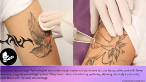 advanced-tattoo-laser-technologies