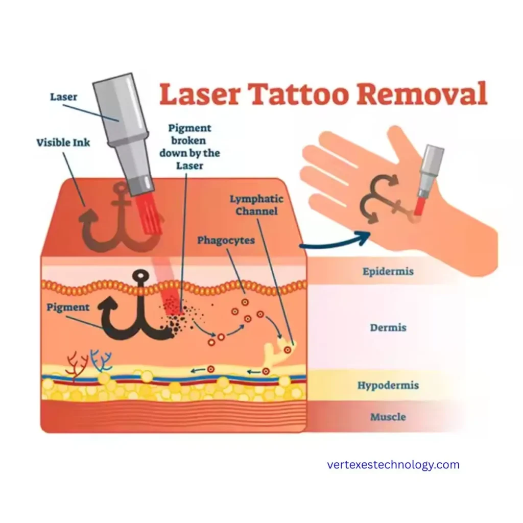 advanced-tattoo-laser-technologies